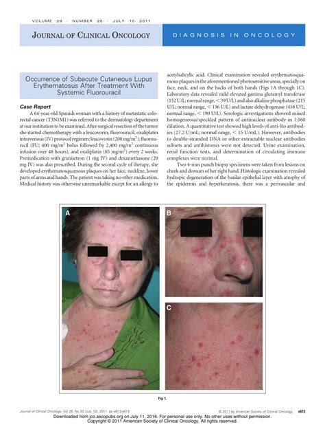 Pdf Occurrence Of Subacute Cutaneous Lupus Erythematosus After
