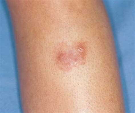 Spider Bites Pictures Symptoms And Treatment