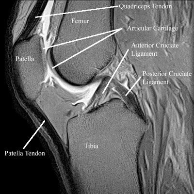 Radiology Anatomy Images Patellar Articular Cartillage In Mri Knee