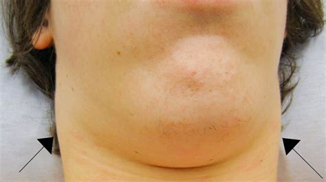 The Best 15 Lymph Nodes Swollen In Jaw Aboutgettybed