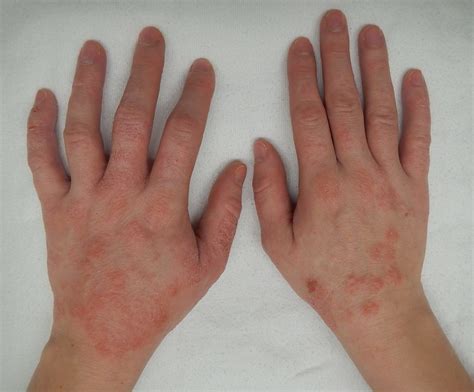 Dermatitis De Contacto ¿por Qué Las Manos Se Irritan Y Tienes Picazón