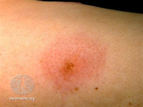 Wasp Stings Symptoms Treatments Prevention