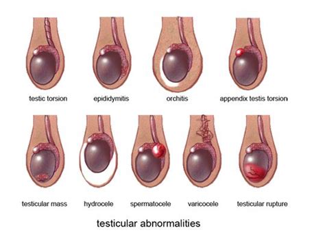 Testicular Abnormalities Diagnostic Medical Sonography