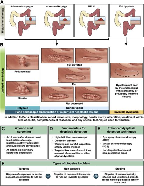 Colonoscopy Pictures Of Ulcerative Colitis
