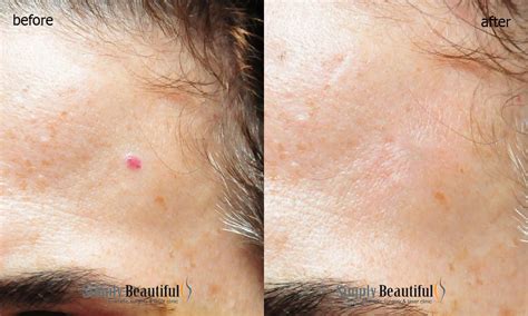 Laser Capillary Removal Dr Peter Kim Surgery Skin Cancer Cosmetic