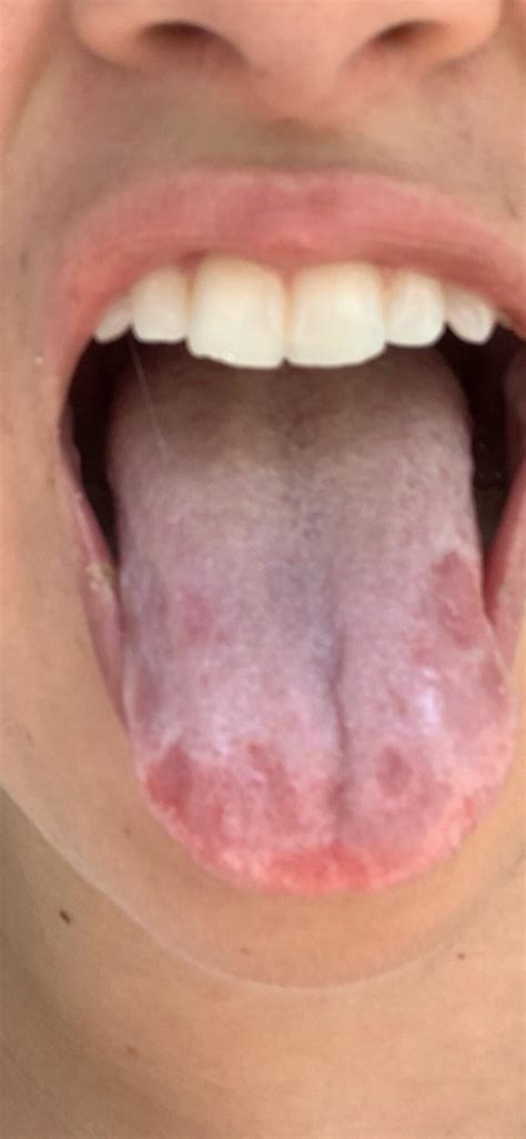 White Spots On Tongue White Spots On Tongue Bumps Pat