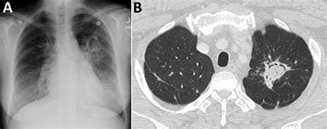 Figure 1 Case Definition Of Chronic Pulmonary Aspergillosis In