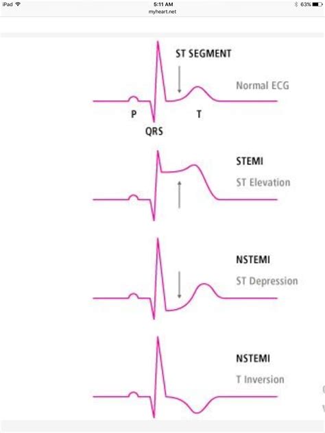 How To Calculate Heart Rate From Ecg 8 Steps With Pictures Artofit
