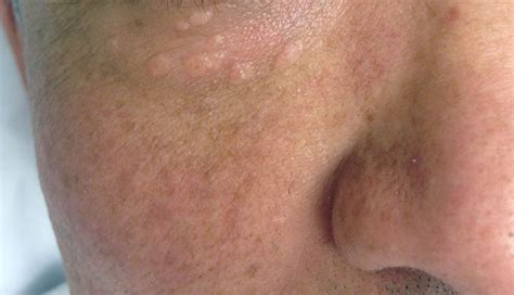 Derm Dx Skin Colored Papules On The Lower Eyelids Clinical Advisor