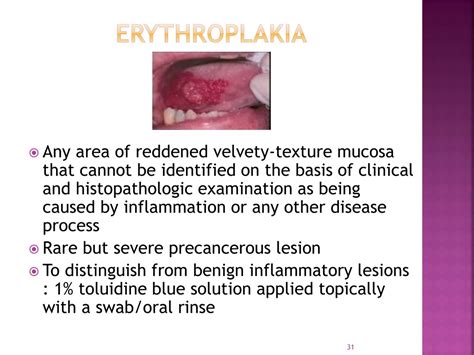 Ppt Epidemiology Etiology And Prevention Of Oral Cancer Powerpoint