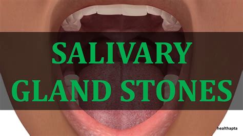 Salivary Gland Stones Youtube