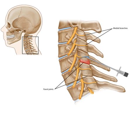 Cervical Medial Branch Blocks Anesthetic Injections Pain Spa