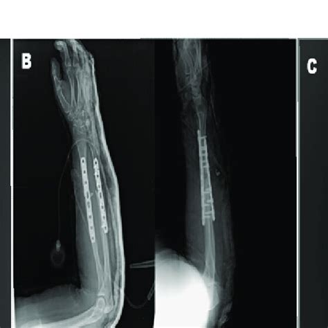 Plate Osteosynthesis A Preoperative Radiograms B Postoperative