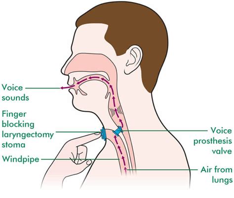 What To Expect After Laryngectomy Surgery Labex Electrolarynxes