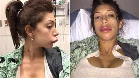 Teen Moms Farrah Abraham Reveals Botched Lip Surgery In Shocking Photos Mirror Online