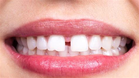 3 Ways To Fix Gaps In Your Teeth Understanding Dental Options