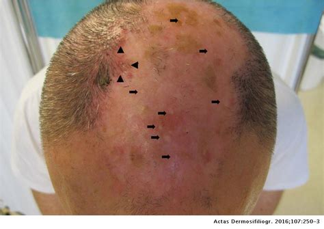 Multiple Secondary Cutaneous Osteomas In A Patient With Folliculitis