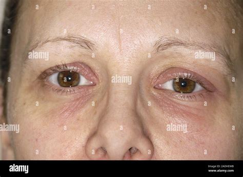 Eczema Affecting The Skin Around A 36 Year Old Womans Eyes This Is