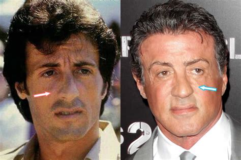 Sylvester Stallone Facelift Before After