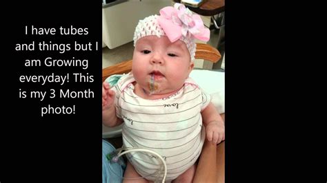 Annabelles Gastroschisis Story Youtube