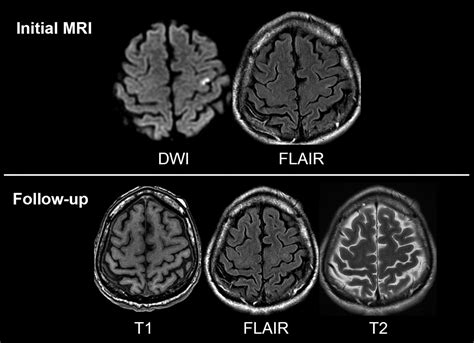 Do Transient Ischemic Attacks With Diffusion Weighted Imaging