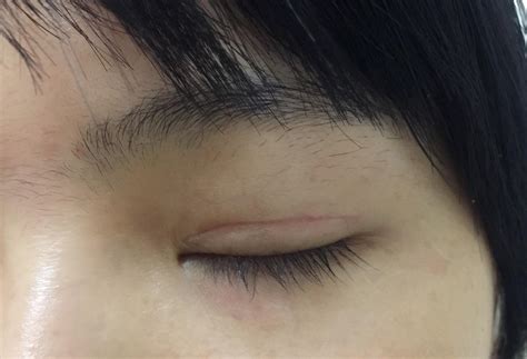 2019 6 13 双眼皮手术全过程 拆线及术后恢复 更新中 知乎