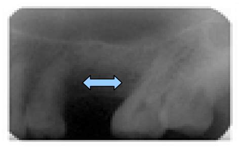 Residual Cyst In Edentulous Lower Jaw Source Morrison A 2014