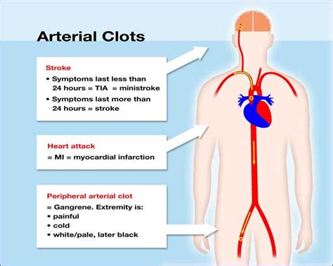 Aortic Blood Clots Causes Symptoms And Treatment Steve Gallik