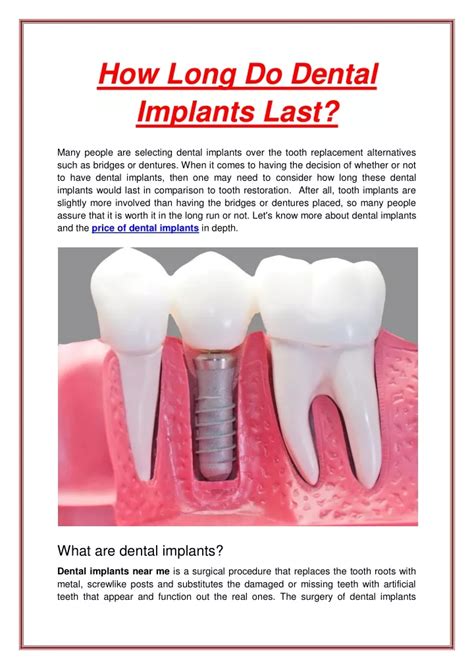 Ppt How Long Do Dental Implants Last Powerpoint Presentation Free