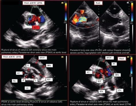 Transthoracic Two Dimensional Echocardiogram Showing Th Open I