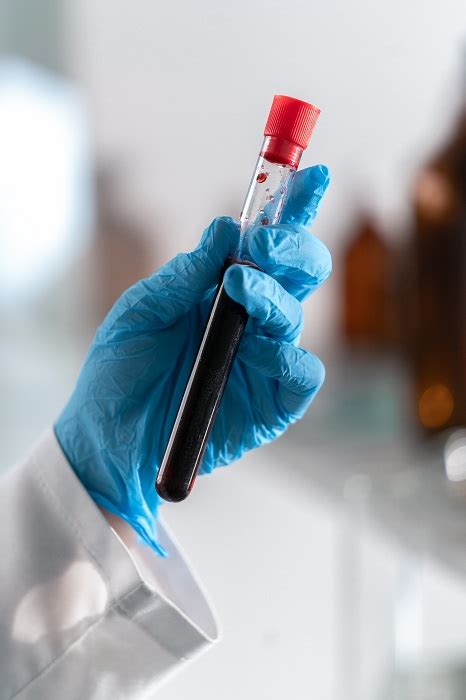 British University To Develop Simple Blood Test For Brain Tumors