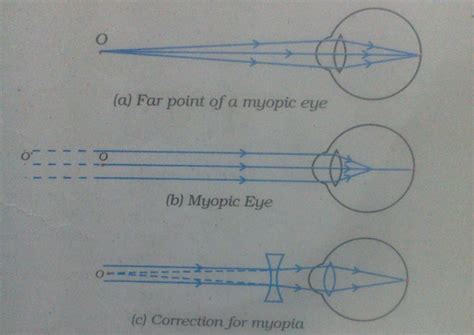 When Do We Consider A Person To Be Myopic Or Hypermetropic Draw A Ray