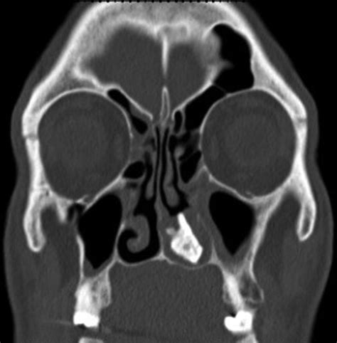 Radial conidia heads dandelion, biserate phialids infections: Fungus ball in the nasal cavity mimicking a rhinolith ...