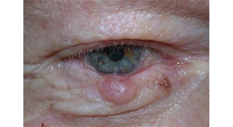 Eyelid Skin Cancer Mivision