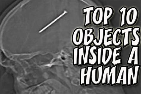 10 Most Horrifying Things Ever Found Inside A Human Body Youtube
