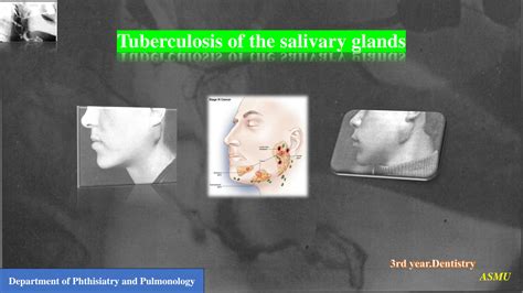 Solution Tuberculosis Of The Salivary Glands Science Studypool