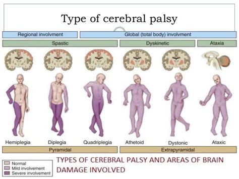 Many cerebral palsy sufferers have a combination of the different types. Cerebral Palsy