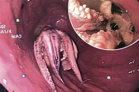 Doctors Flabbergasted After Finding Octopus In Patients Throat