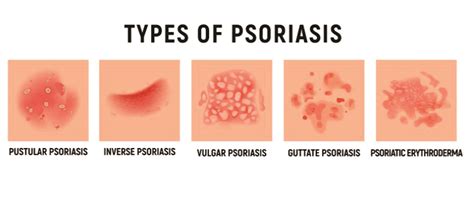 Types Of Psoriasis People Tree Hospitals