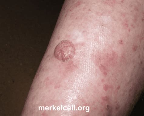 Images Of Merkel Cell Carcinoma Skin Cancer Cancerwalls