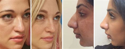Rhinoplasty Before And After Uk Wide Nose Bulbous Rounded Nasal Tip Photos