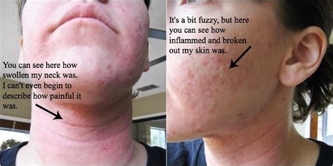 Hypothyroidism Skin Rash Pictures Photos
