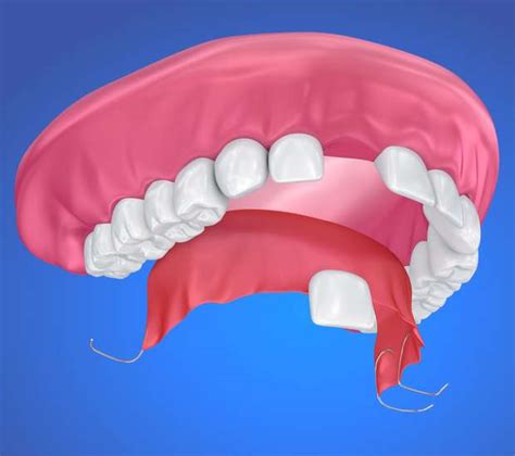Partial Denture For One Missing Tooth Houston Tx Bridge The Gap