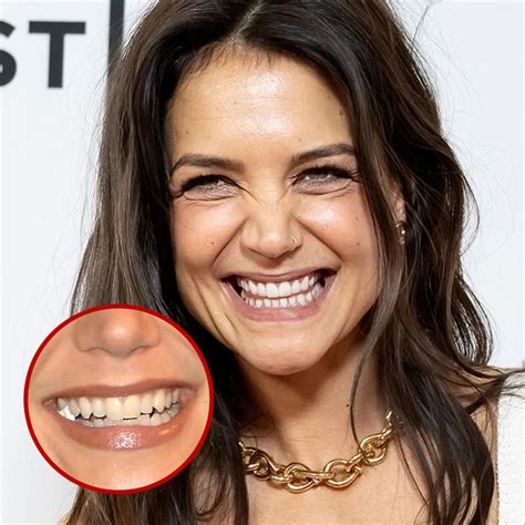 Celebrity Dental Implants And Veneers Before And After
