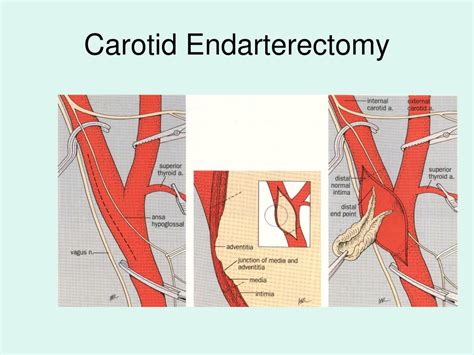 Ppt Surgical Intervention For Carotid Artery Disease Powerpoint
