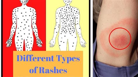 Common Rashes Skin Chart