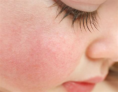 Red Cheeks In A Toddler Possible Causes And What You Can Do