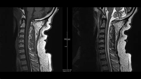 Noncontrast Mri Cervical Spine Search Pattern Youtube