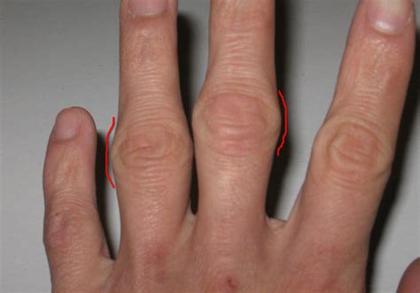 Ukc Articles Injury Management And Prevention Fingers