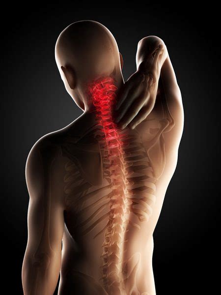 Neck Pain Types Symptoms Causes What To Do Physio Pretoria